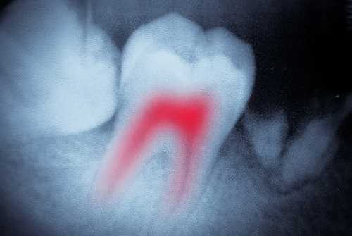 julyrootcanal